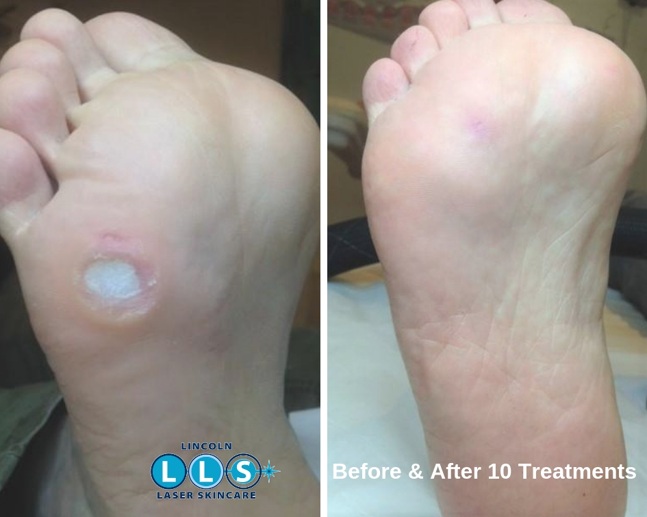 Warts & Removal Lincoln Laser Skin Care