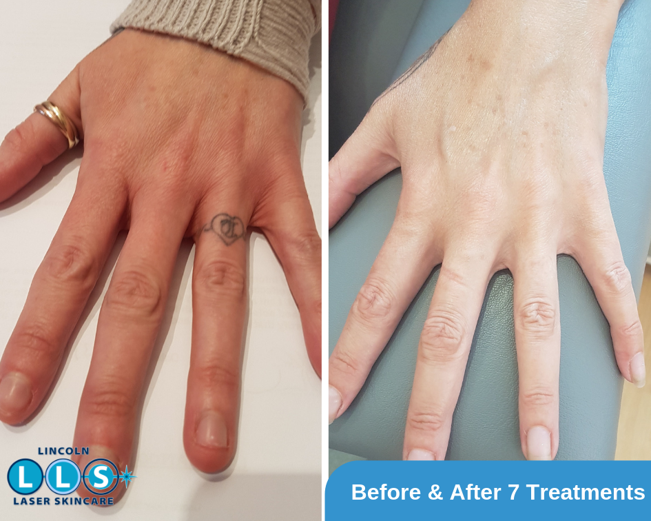 Example of Tattoo Removal on the Finger with 1 treatment