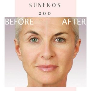 Sunekos Treatment
